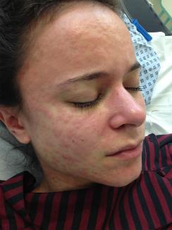 Measles rash on face