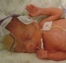 Hypotension in the Preterm Infant