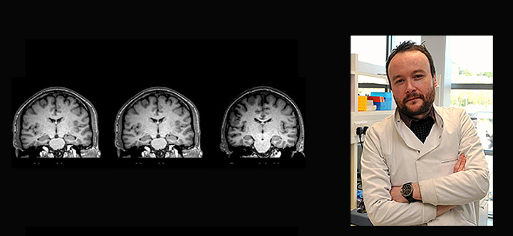 Recreational Cannabis Changes the Brain in Young People? – Dr. Downer gives view