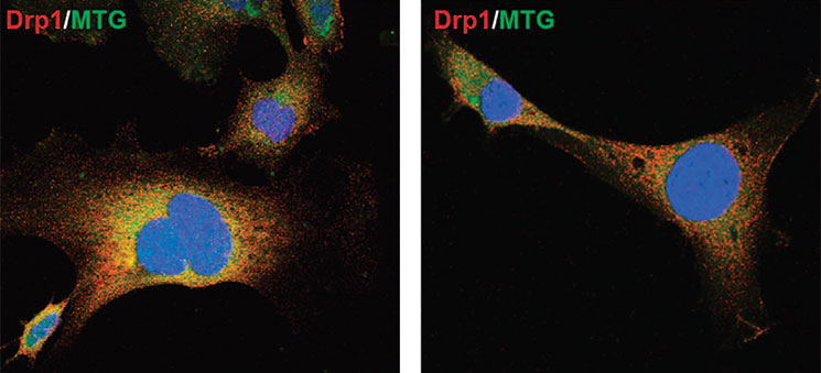 Loss of function mutations in the PINK1 gene cause Parkinson’s disease.