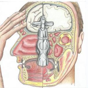 Some clinical features of sinusitis, post-nasal drip and headache